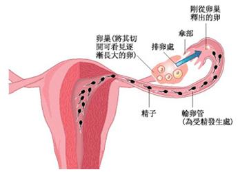 輸卵管積水保守治療